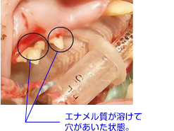 歯頚部吸収病巣